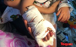 Bàn tay của bé trai 17 tháng bị kẹp ở thang cuốn sân bay có thể bị hoại tử