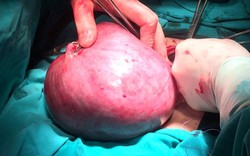 Phẫu thuật cắt bỏ khối u xơ tử cung cho người phụ nữ mang bầu 5 tháng