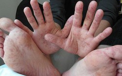 Hà Nội: Xuất hiện 10 trường hợp trẻ mắc tay chân miệng do nhiễm chủng EV71