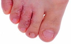 Những bệnh ngoài da thường gặp vào mùa hè