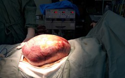 Phẫu thuật thành công khối u buồng trứng khổng lồ hơn 5kg
