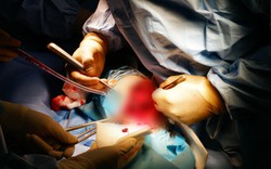 Ca phẫu thuật nối chân gãy cho bệnh nhân 'không thể truyền máu'