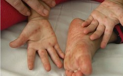 Bệnh tay chân miệng tăng gấp 5: Chỉ đạo khẩn từ Sở y tế TP HCM