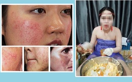 Kem trộn: Tác nhân kinh hoàng khiến da mặt bị nhiễm corticoid bị tổn thương nghiêm trọng, mài mòn, viêm nhiễm mãn tính