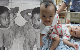 32 năm về trước Việt Nam từng có một ca phẫu thuật tách rời đi vào lịch sử, có điểm tương đồng đặc biệt với cặp song sinh Trúc Nhi - Diệu Nhi