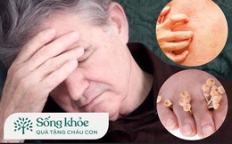 Sau 50 tuổi, 4 căn bệnh ngoài da nguy hiểm này sẽ lần lượt &quot;tấn công&quot; người già, nhận biết sớm để phòng tránh kẻo muộn