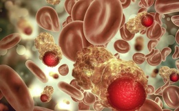 Ung thư máu có di truyền không?