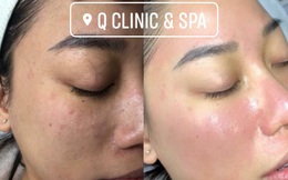 Q Clinic & Spa chia sẻ 6 lưu ý trang điểm khi da bị mụn