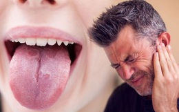 Lưỡi xuất hiện vết loét như nhiệt miệng, rất khó chịu nhưng vài ngày tự mất: Cảnh báo căn bệnh có khả năng ''ĐÁNH LỪA'' bác sĩ nên ai cũng dễ bỏ qua