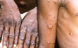 Thông tin về bệnh đậu mùa khỉ theo WHO: Trường hợp nghi ngờ mắc bệnh, biện pháp phòng ngừa