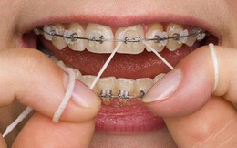 4 lưu ý cần nhớ khi chăm sóc răng dành riêng cho “hội đang niềng răng”