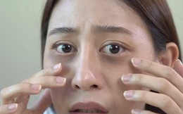 Dấu hiệu trên cơ thể cảnh báo gan có vấn đề, cảnh giác sớm không thừa