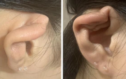 Nữ sinh 15 tuổi xỏ lỗ tai gây viêm màng sụn, biến dạng vành tai, chuyên gia cảnh báo