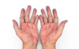 Thấy 3 dấu hiệu này ở bàn tay, có thể bạn đang mắc gan nhiễm mỡ nặng