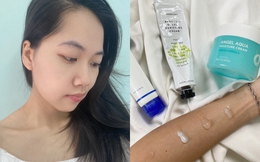 Cách &quot;giải cứu&quot; làn da bị cháy nắng, mẩn đỏ sau khi đi nắng
