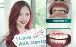 Chuyên gia cảnh báo bọc răng sứ giá rẻ gây nguy hiểm sức khỏe người dùng