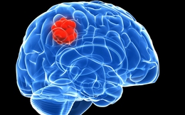 Người phụ nữ phát hiện u não từ dấu hiệu bất thường khi ngủ dậy

