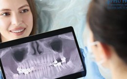 Công nghệ trồng răng implant vượt trội tại Nha khoa Quốc tế Phú Hòa