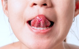 5 điều lưỡi có thể tiết lộ về sức khỏe - từ ung thư đến nguy cơ đột quỵ cũng có thể hiện ra