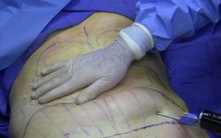 Hút mỡ bụng, một cô gái 25 tuổi bóng đá tỷ lệ kèo nhà cái