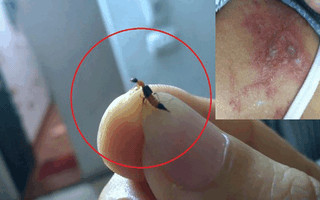 Nhiều người bị viêm da do tiếp xúc với kiến kèo nhà cái trực tiếp euro: Phân biệt kiến kèo nhà cái trực tiếp euro đốt và bệnh zona