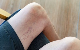 Biến chứng nguy hiểm của kèo nhà cái w88 suy giãn tĩnh mạch 2 chi dưới và cách khắc phục