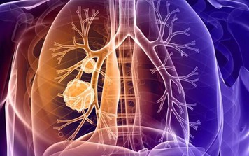 2 vị trí đau bất thường cảnh báo ung thư phổi nhưng dễ bị bỏ qua