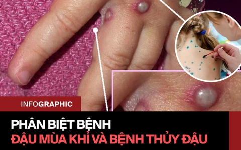 Phân biệt bệnh đậu mùa khỉ và thủy đậu: Triệu chứng, sự lây truyền và kèo cá cược nhà cáin thương khác nhau thế nào?