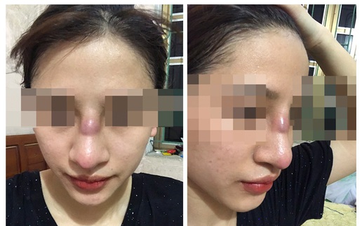 Kinh hãi nhìn chiếc mũi biến dạng sau khi nâng của cô gái 19 tuổi